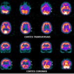 cerebral_spect