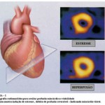 cintilografiamiocardio