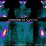 Cintilografia-paratireoides