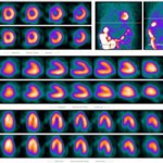 Cintilografia_tireoide